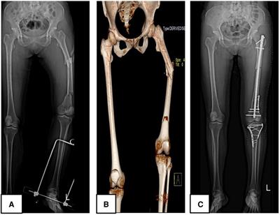 The current issues and challenges in the management of floating knee injury: a retrospective study